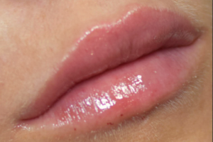 After - Lip Filler