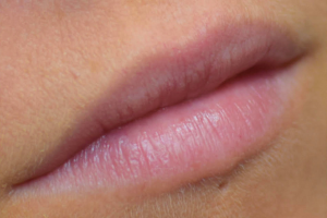 Before - Lip Filler