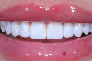 After - Composite Bonding