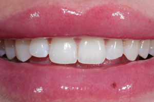 Before - Composite Bonding