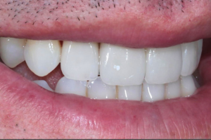 After - Invisalign