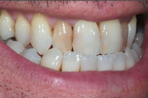 Before - Invisalign