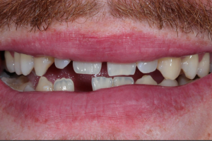 Before - Porcelain Veneers