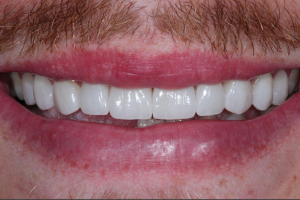After - Porcelain Veneers